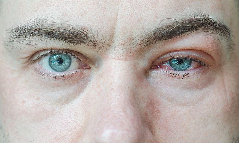 ασθένειες-στα-μάτια-από-τον-ήλιο-αντιμετώπιση-