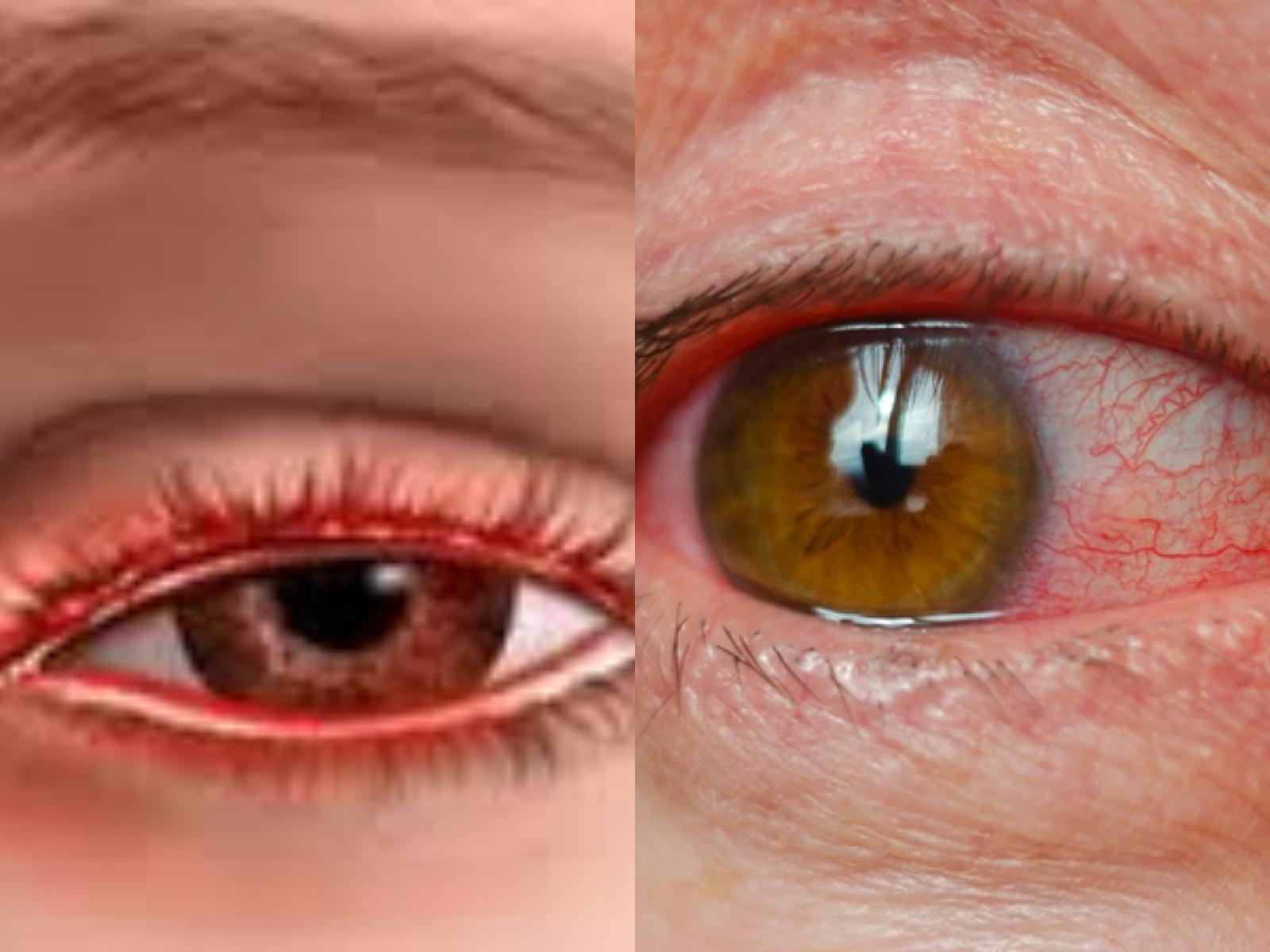 Το Καλοκαίρι τα μάτια μας κινδυνεύουν: Τρόποι να τα προστατεύσεις από τον ήλιο