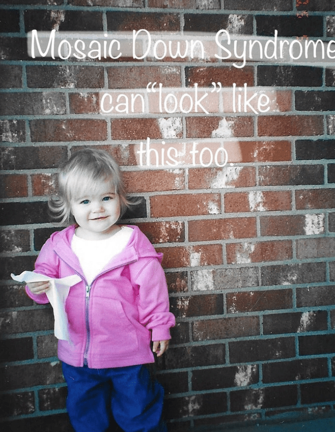 είχε-σύνδρομο down-και-το-έμαθε-στα-20-της-χρόνια-άγνωστα συμπτώματα-