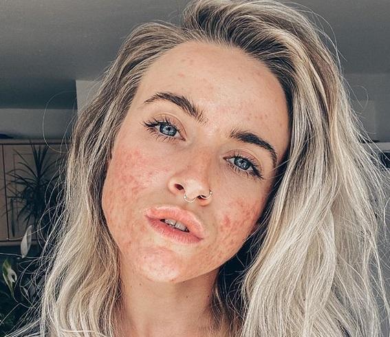 ακμή-στην-εφηβεία-πως-αντιμετωπίζεται-συμβουλές- ακμή-στην-εφηβεία-πως-αντιμετωπίζεται-συμβουλές-