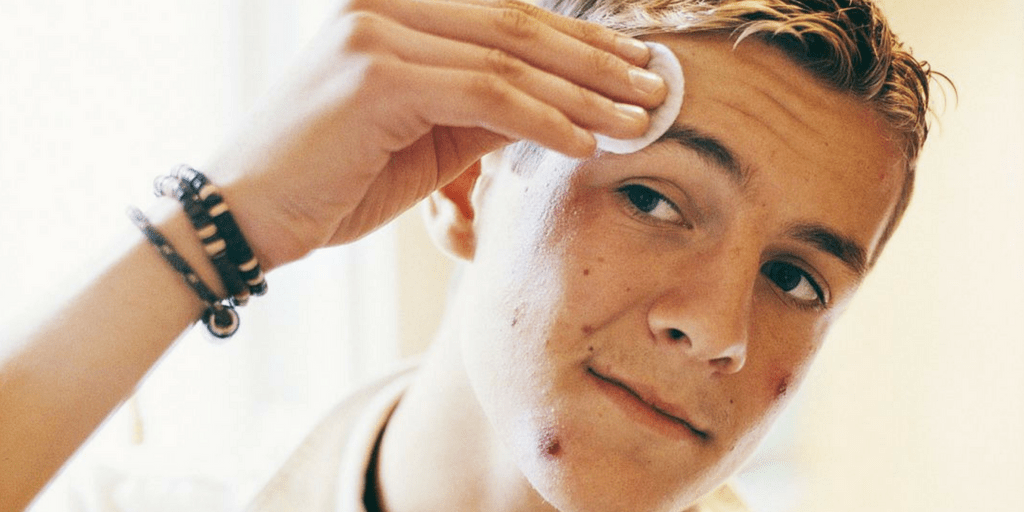 ακμή-στην-εφηβεία-πως-αντιμετωπίζεται-συμβουλές- ακμή-στην-εφηβεία-πως-αντιμετωπίζεται-συμβουλές-