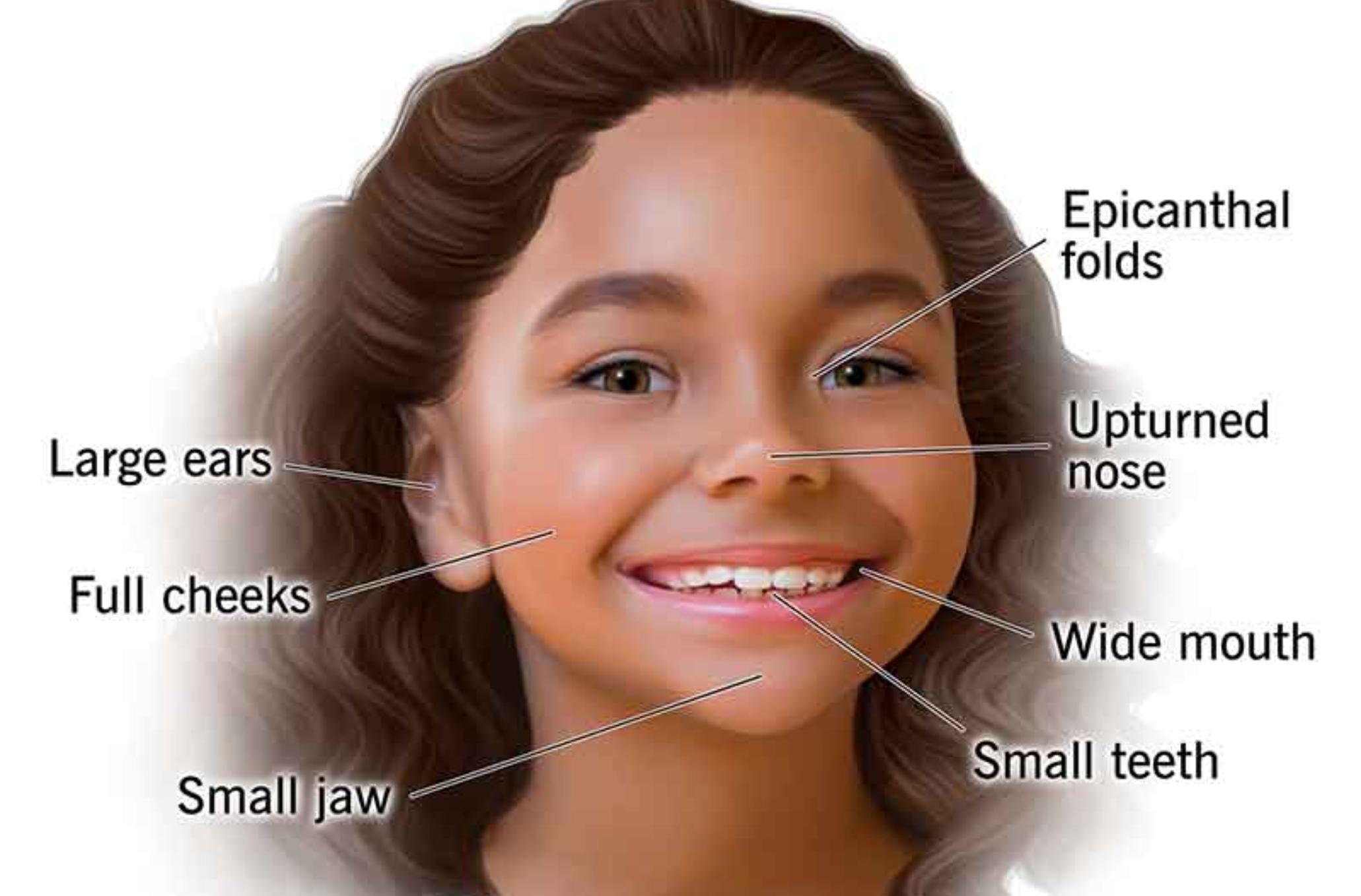 Σύνδρομο Williams το Σύνδρομο των Ξωτικών: Μια σπάνια γενετική διαταραχή που έχει χαρακτηριστεί ως το αντίθετο του αυτισμού