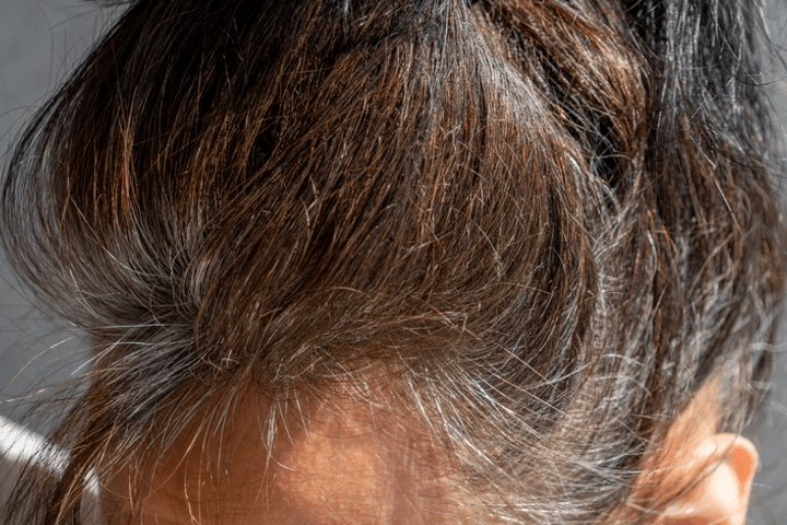 Γκρίζα μαλλιά: Η βιταμίνη που θα βοηθήσει τα μαλλιά να μην γκριζάρουν εύκολα