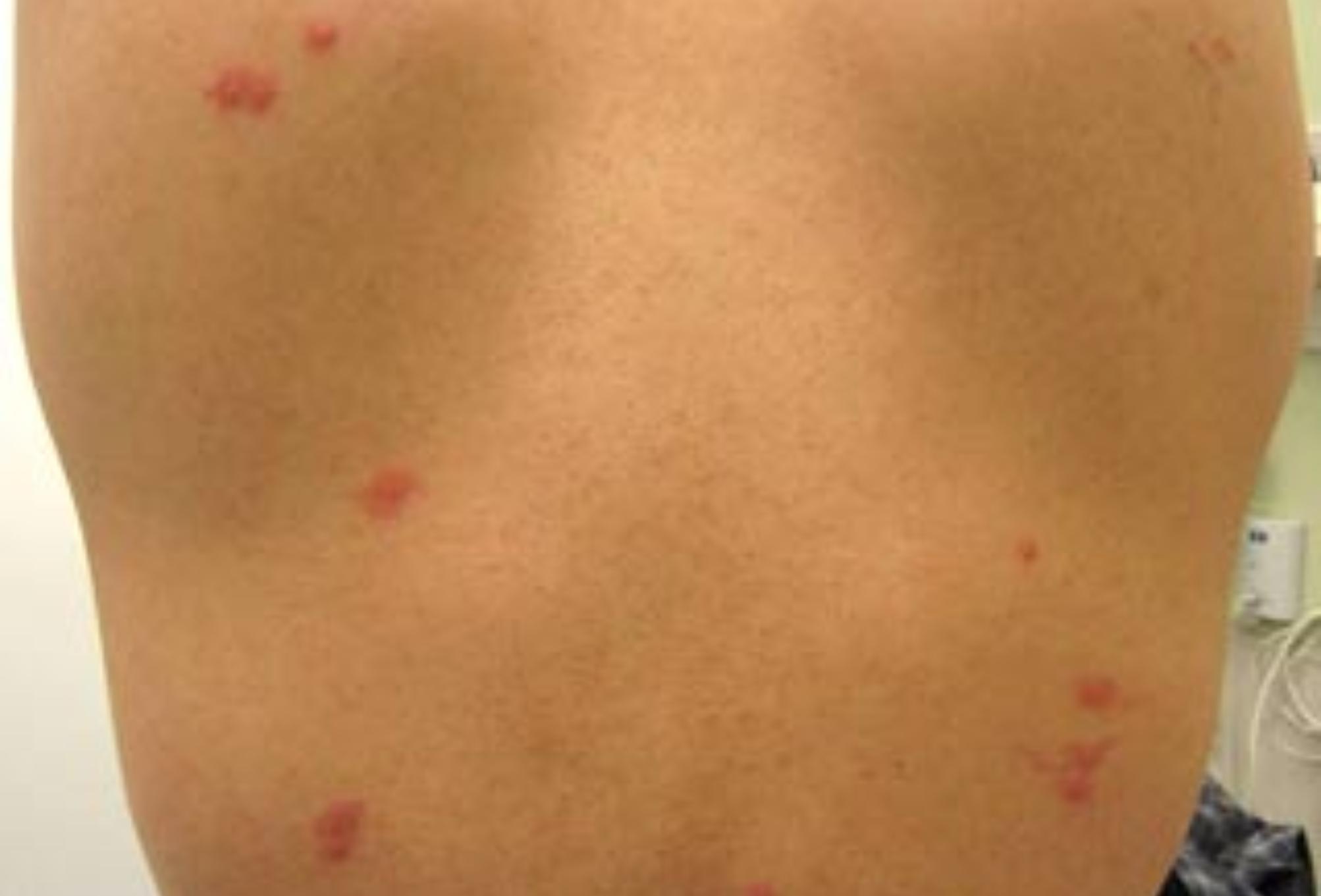 Κοριοί βαμπίρ: Πως είναι το τσίμπημα τους (φωτογραφίες) και πως να τους εξολοθρεύσεις οριστικά