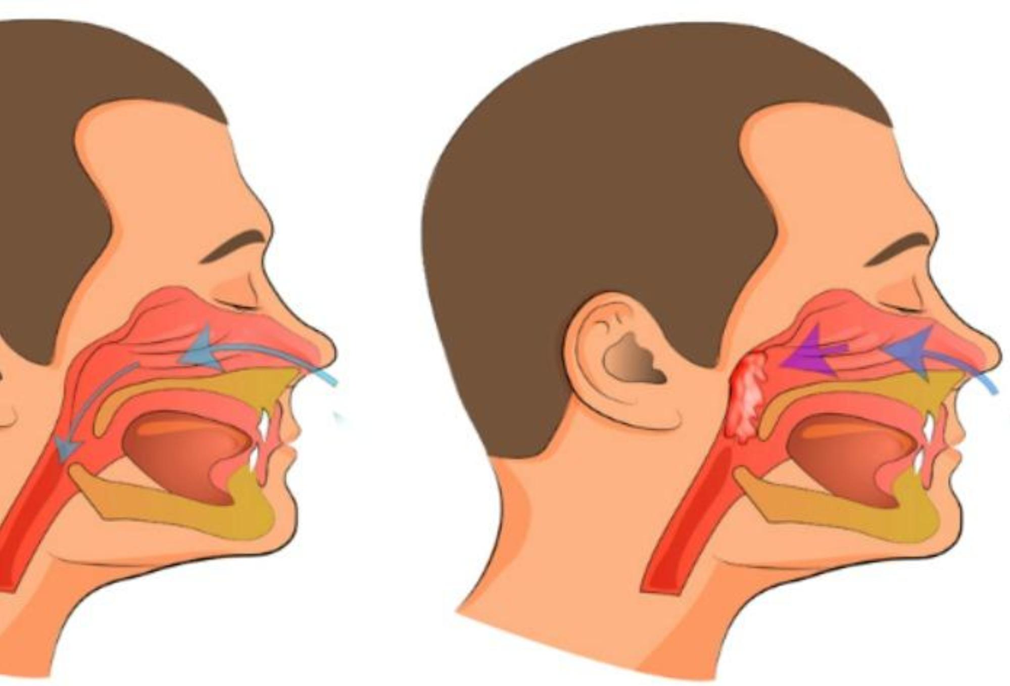 Μπούκωμα καταρροή και βουλωμένη μύτη: Δείτε να το αντιμετωπίσετε γρήγορα φυσικά και να αναπνεύσετε πάλι ελεύθερα