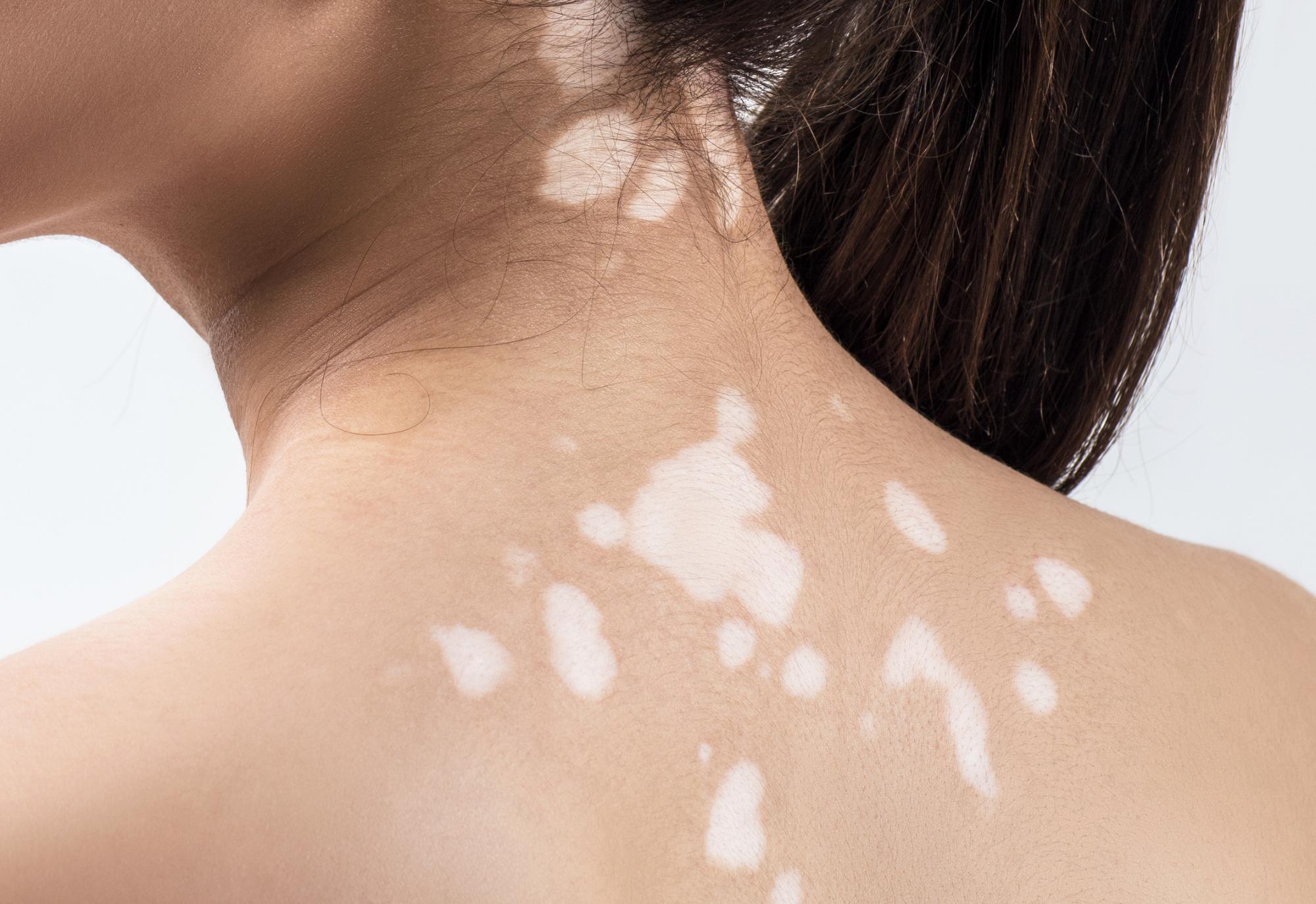 Λευκές κηλίδες στο πρόσωπο: Οι ασθένειες που τις προκαλούν και ποιες οι θεραπείες