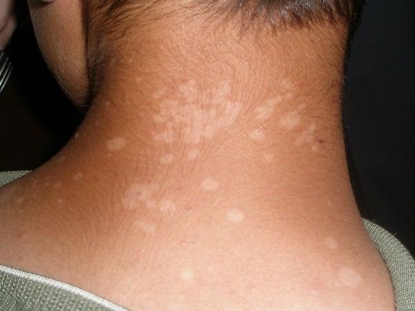 Λευκές κηλίδες στο πρόσωπο: Οι ασθένειες που τις προκαλούν και ποιες οι θεραπείες