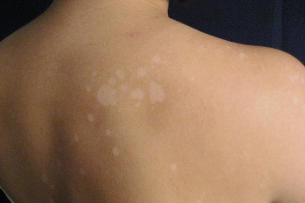 Λευκές κηλίδες στο πρόσωπο: Οι ασθένειες που τις προκαλούν και ποιες οι θεραπείες