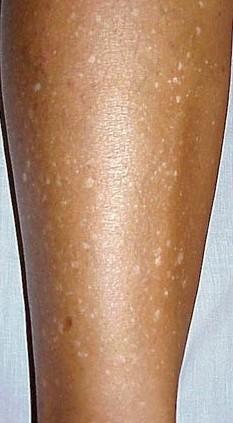 Λευκές κηλίδες στο πρόσωπο: Οι ασθένειες που τις προκαλούν και ποιες οι θεραπείες