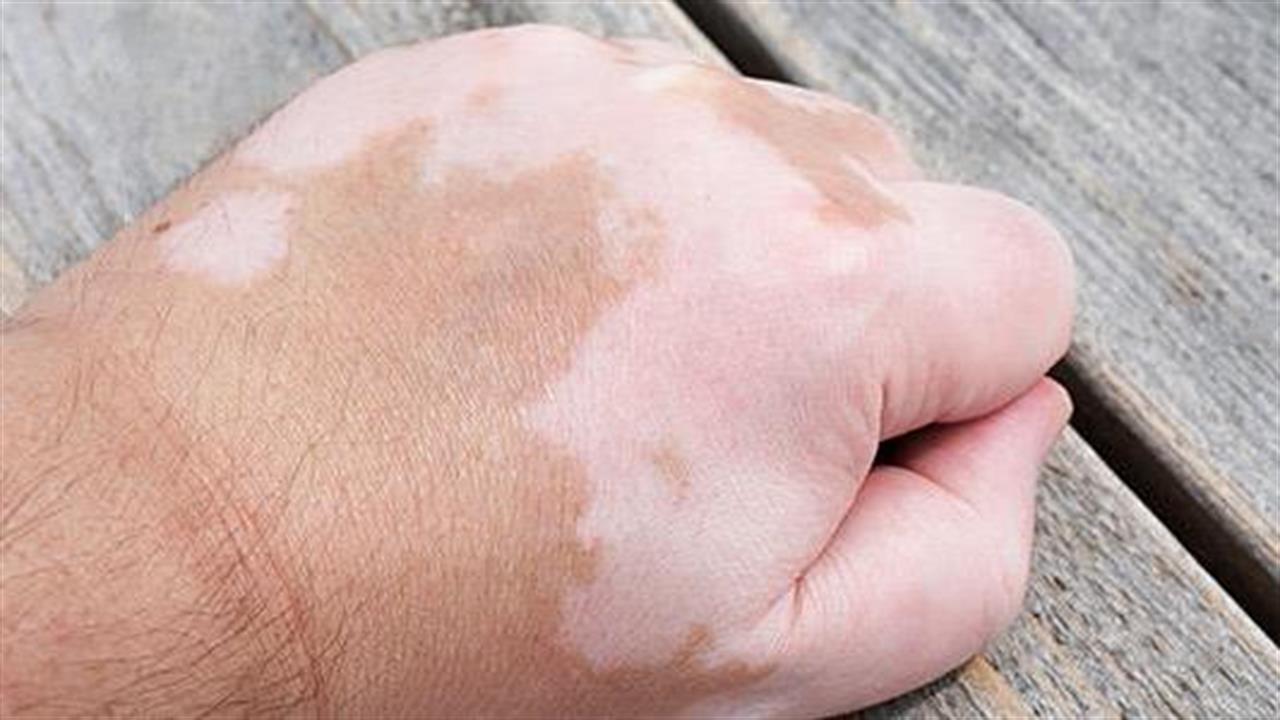 Λευκές κηλίδες στο πρόσωπο: Οι ασθένειες που τις προκαλούν και ποιες οι θεραπείες