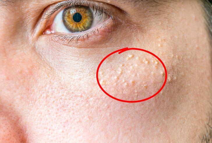 Λευκές κηλίδες στο πρόσωπο: Οι ασθένειες που τις προκαλούν και ποιες οι θεραπείες
