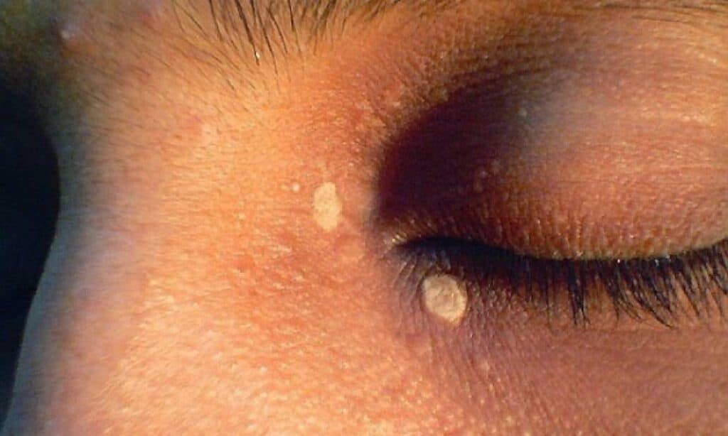 Λευκές κηλίδες στο πρόσωπο: Οι ασθένειες που τις προκαλούν και ποιες οι θεραπείες