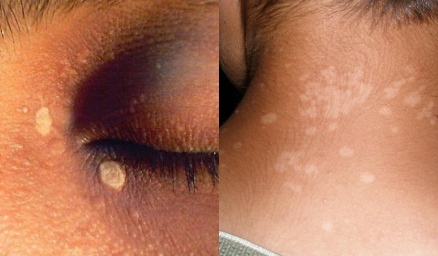 Λευκές κηλίδες στο πρόσωπο: Οι ασθένειες που τις προκαλούν και ποιες οι θεραπείες