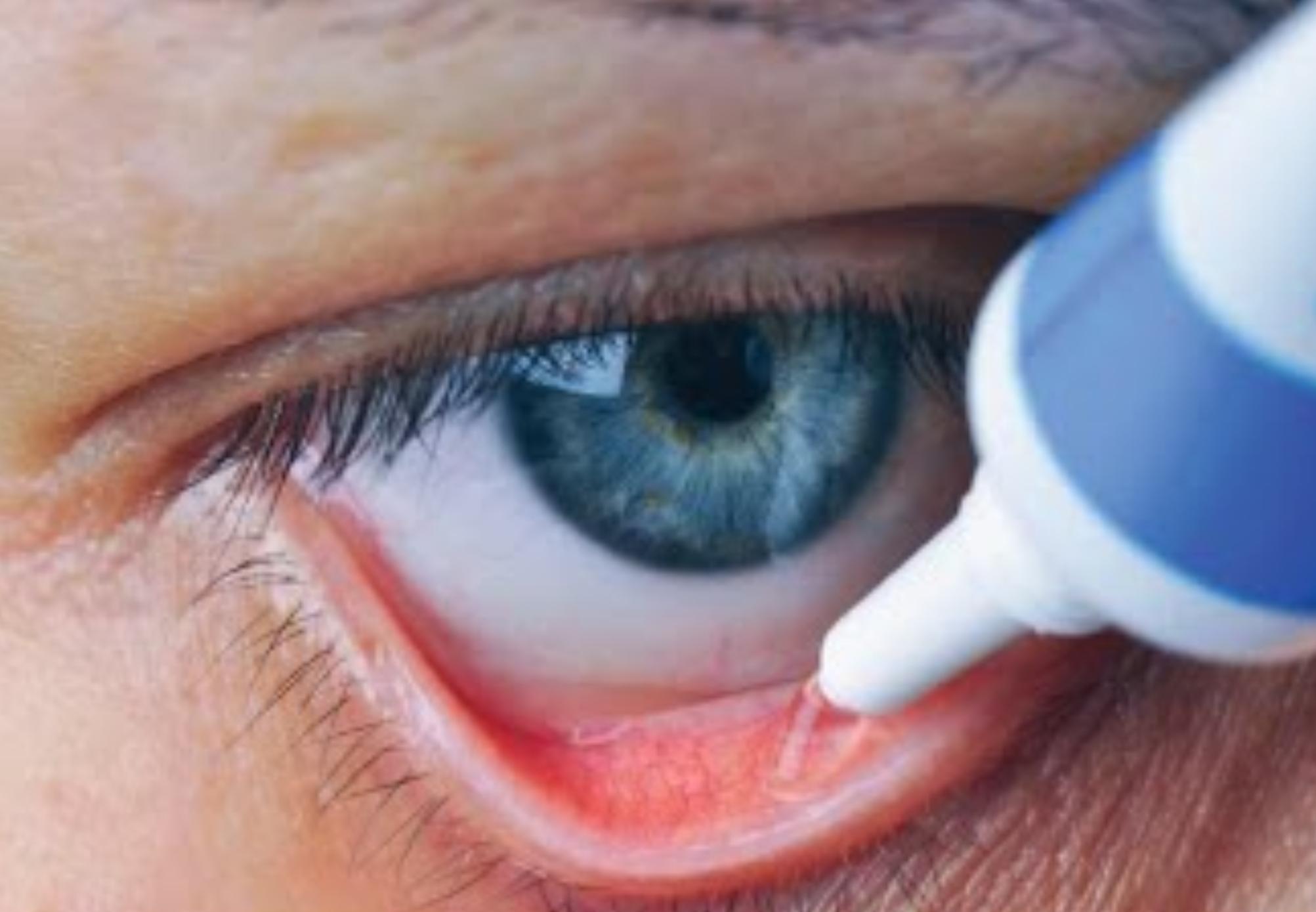 Ο ΕΟΦ ανακαλεί γνωστή φαρμακευτική αλοιφή λόγω πιθανής επιμόλυνσης