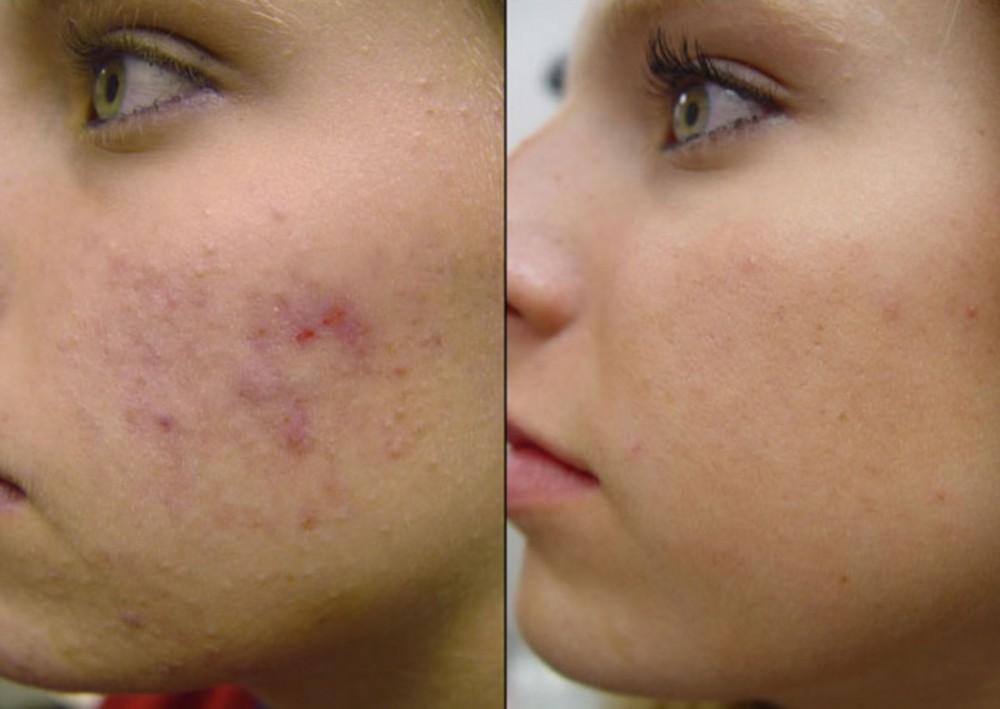 μάσκα προσώπου-με-ρύζι-και-μέλι-για-ακμή- μάσκα προσώπου-με-ρύζι-και-μέλι-για-ακμή-