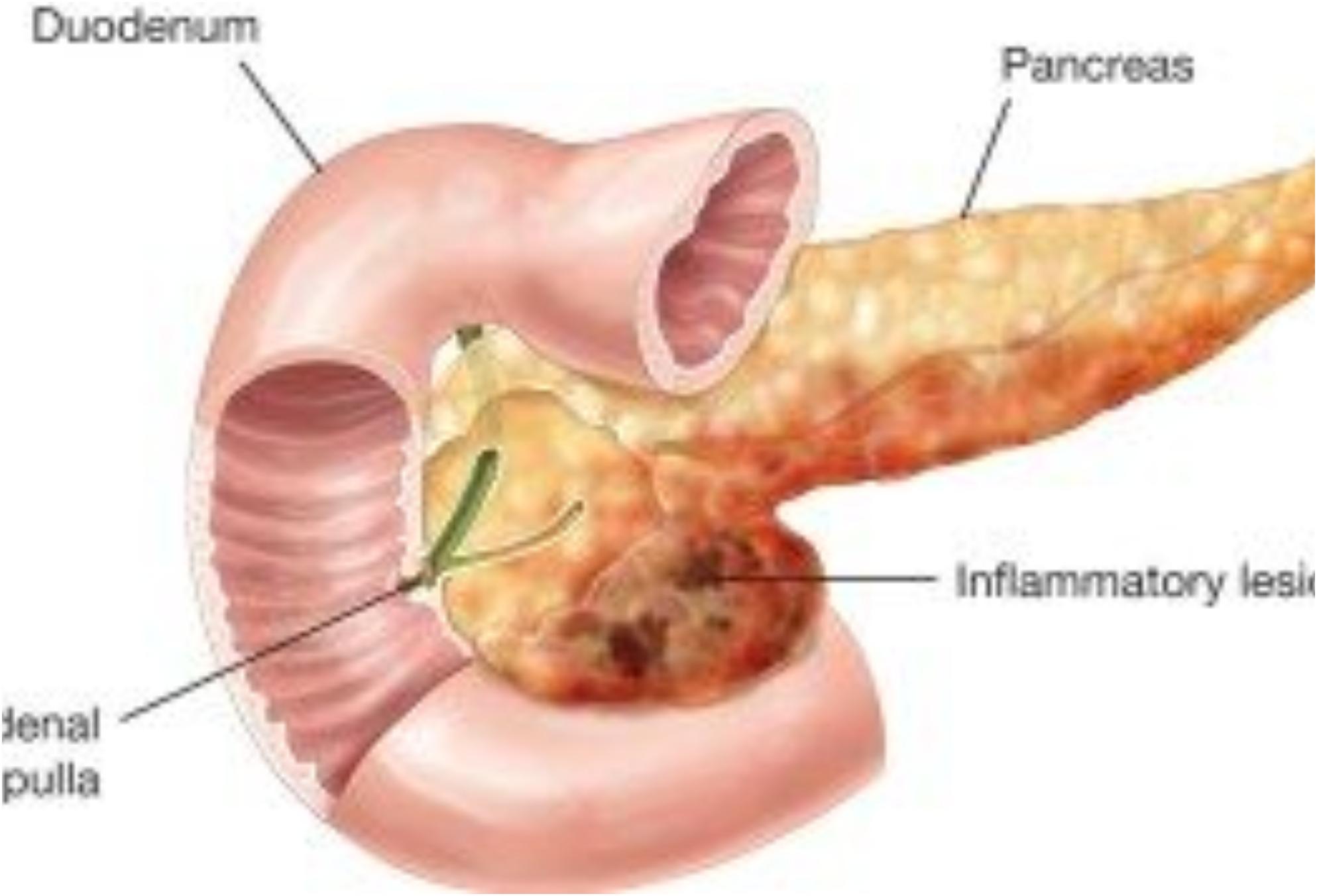 παγκρεατίτιδα