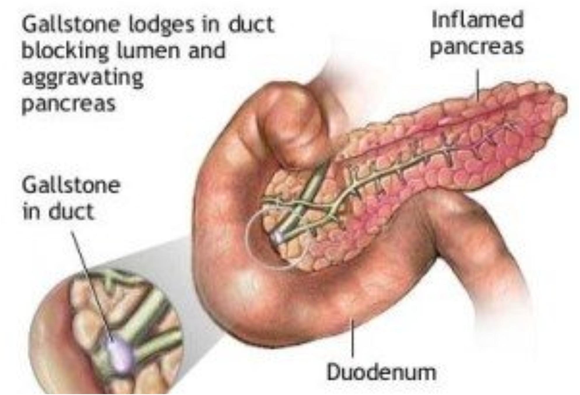 παγκρεατίτιδα