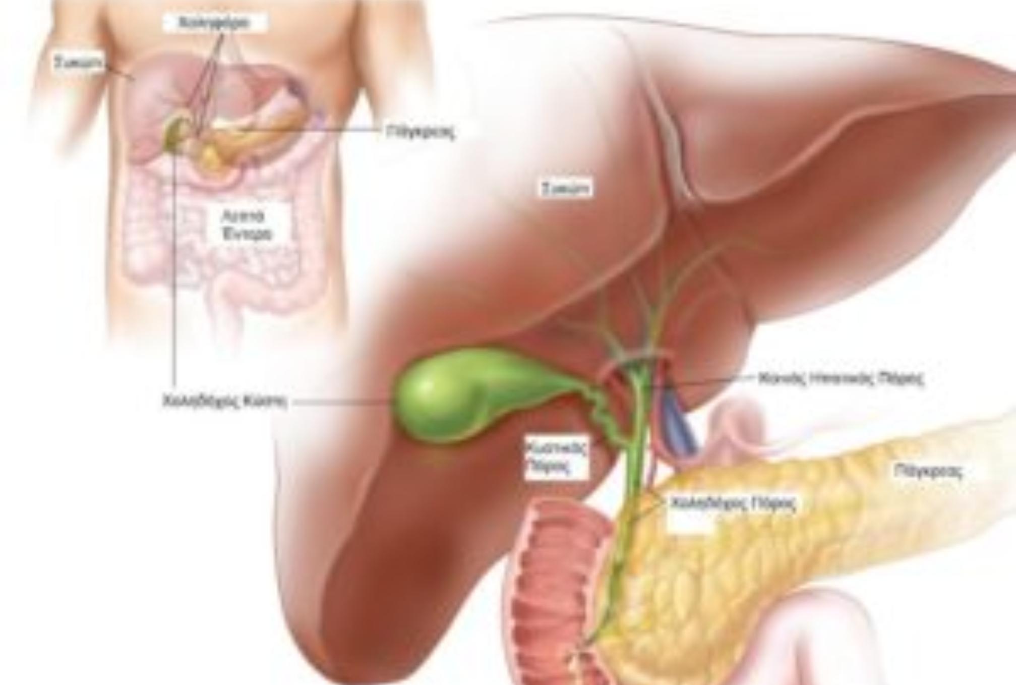 Πέτρες στη χολή ή Χολολιθίαση: Ποια είναι τα συμπτώματα και ποια η θεραπεία