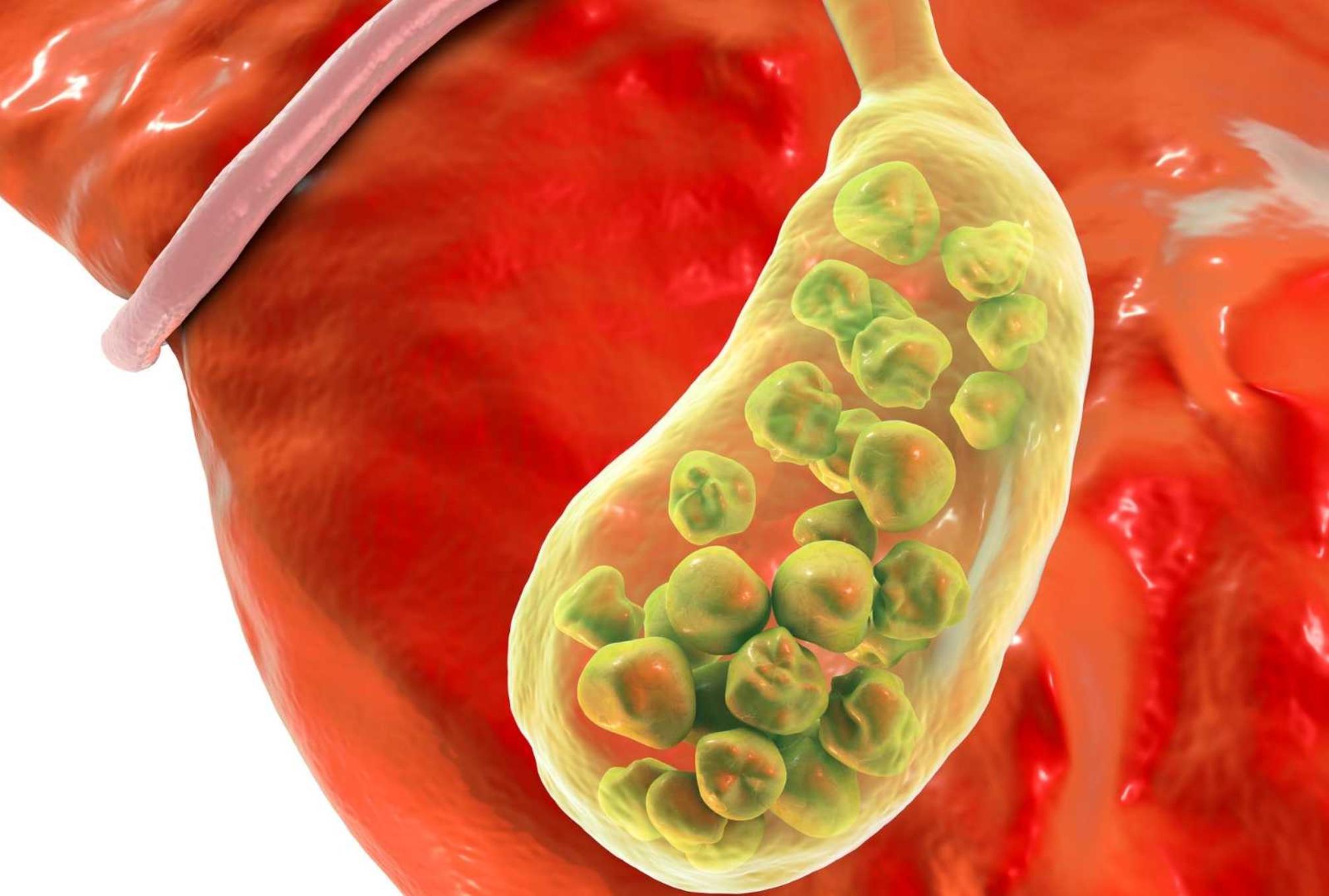 Πέτρες στη χολή ή Χολολιθίαση: Ποια είναι τα συμπτώματα και ποια η θεραπεία