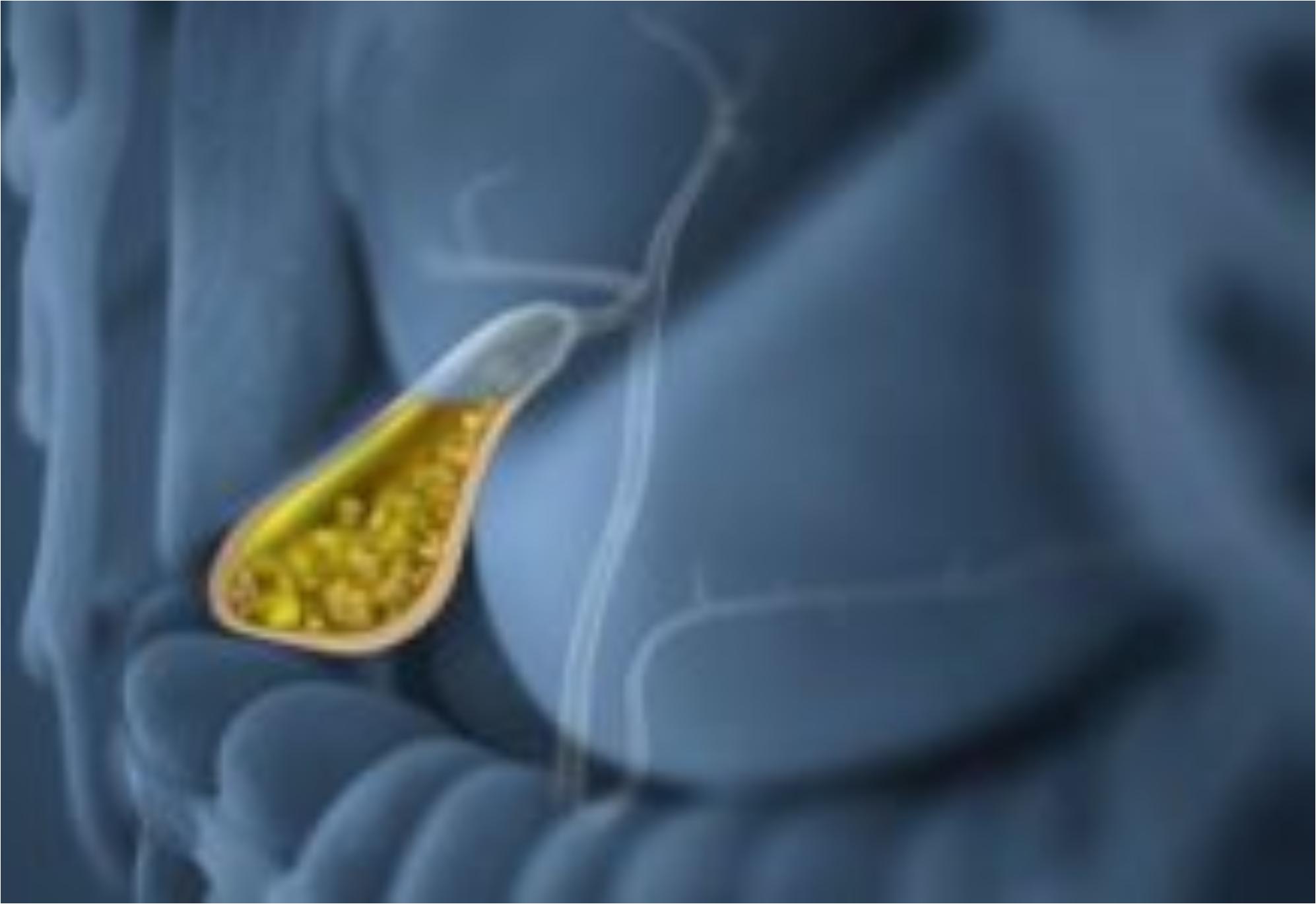 Πέτρες στη χολή ή Χολολιθίαση: Ποια είναι τα συμπτώματα και ποια η θεραπεία