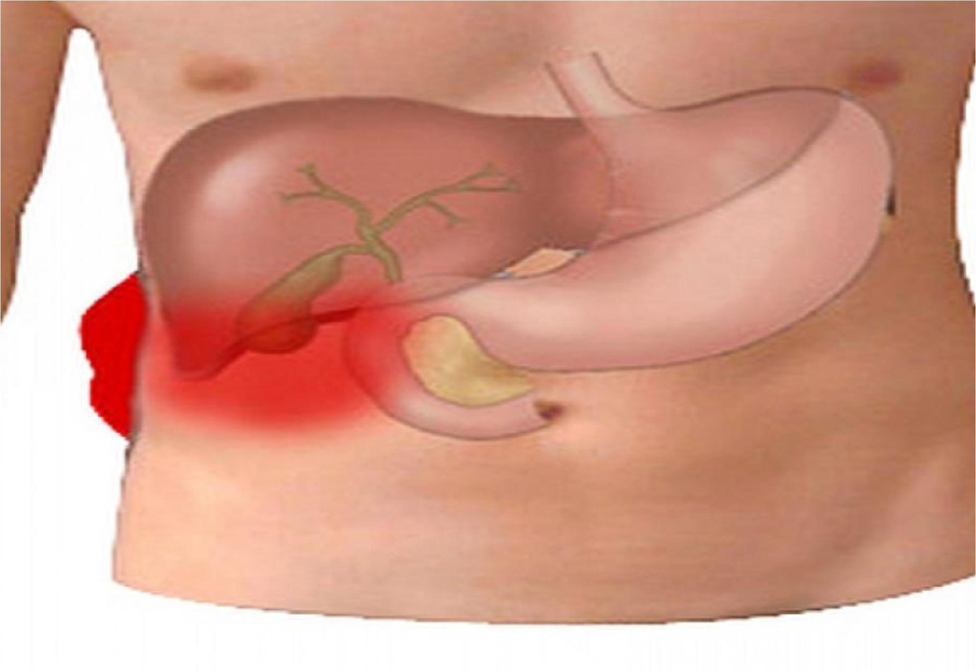 Πέτρες στη χολή ή Χολολιθίαση: Ποια είναι τα συμπτώματα και ποια η θεραπεία