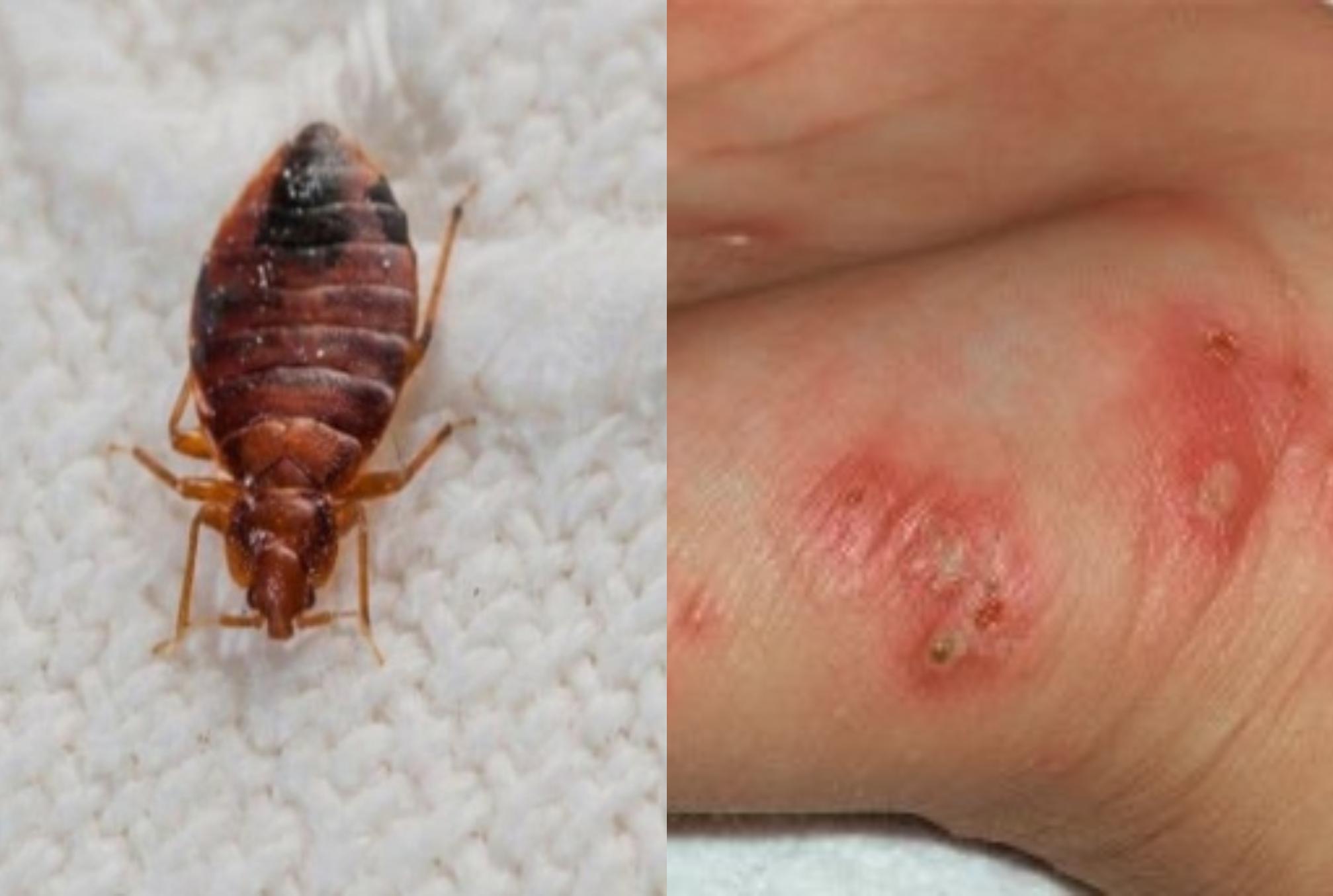 Ψώρα: Το άκαρι της ψώρας – Τι παράσιτο είναι πώς μεταδίδεται και πώς το εξαλείψετε