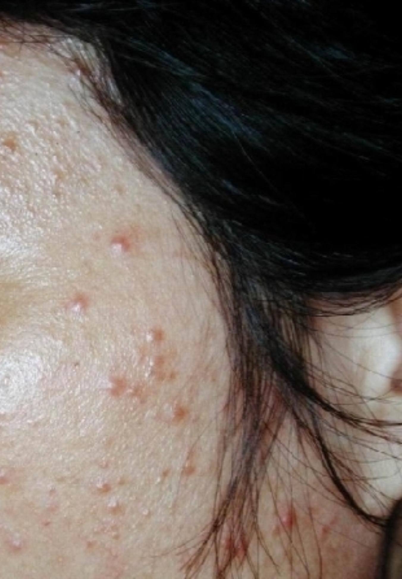 Ψώρα: Το άκαρι της ψώρας – Τι παράσιτο είναι πώς μεταδίδεται και πώς το εξαλείψετε