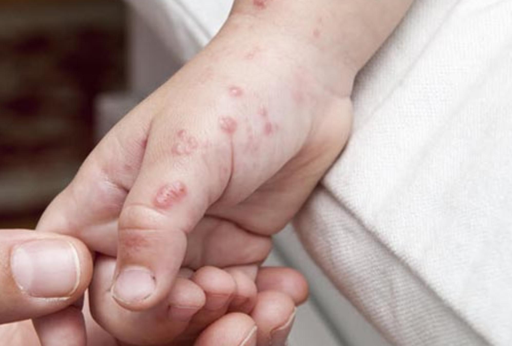 Σε έξαρση ο ιός κοξάκι στα παιδιά: Οι επικίνδυνες παρενέργειες και τα συμπτώματα  