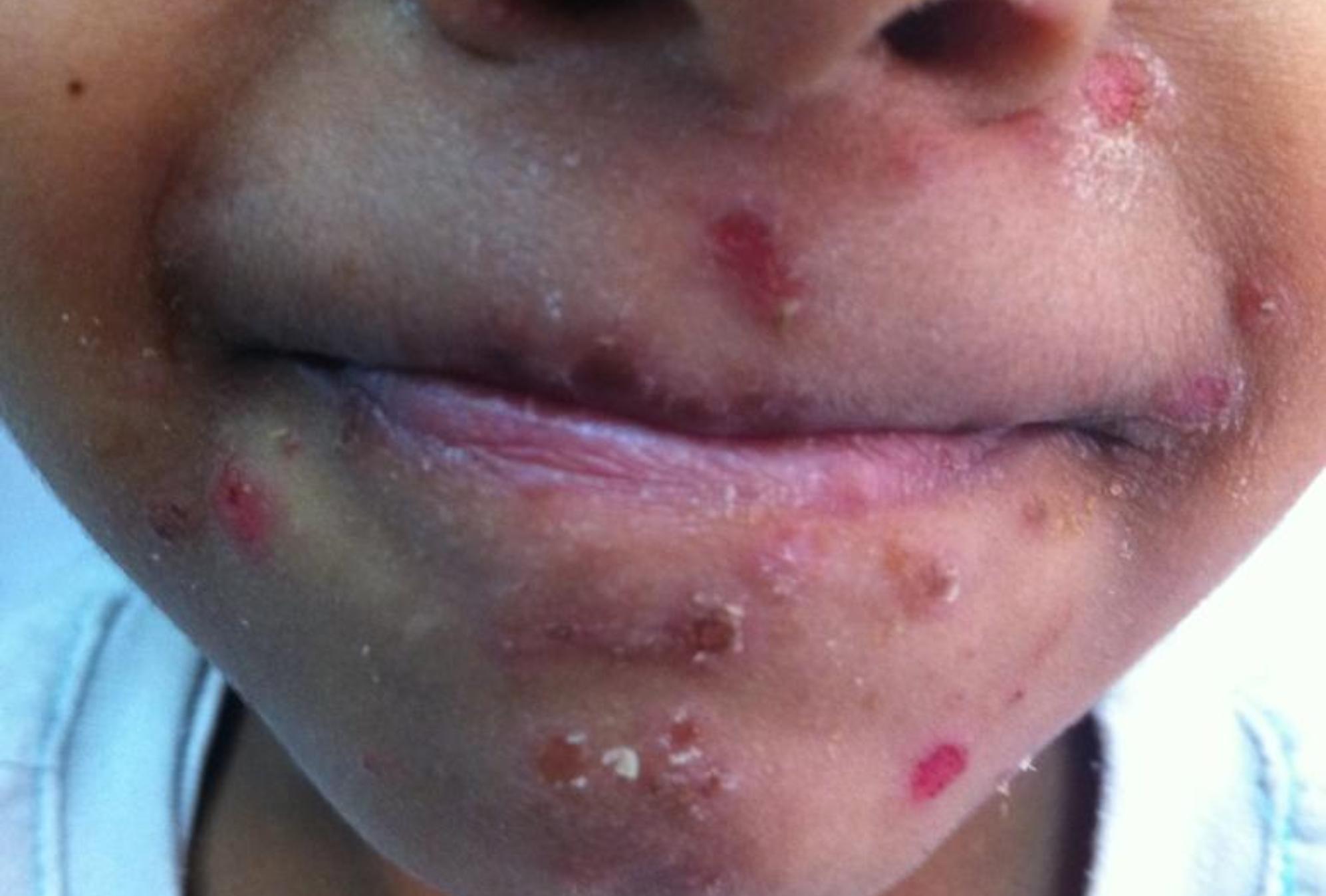 Ιός-κοξάκι-στα-παιδιά-τα-επικίνδυνα-συμπτώματα-που-οφείλουν-να-προσέχουν-οι-γονείς