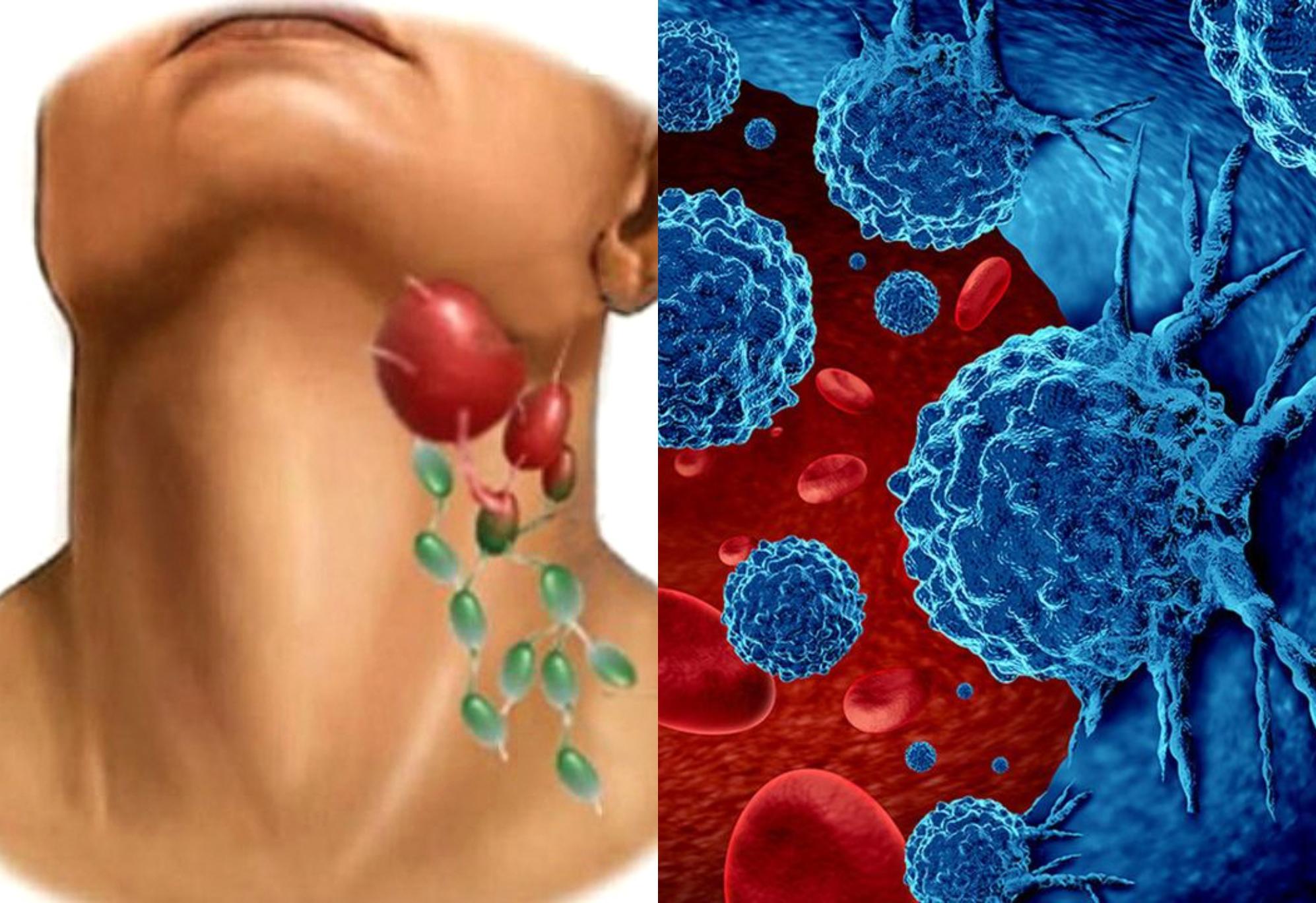 Λέμφωμα- Η νόσος που τα συμπτώματα της θυμίζουν γρίπη: Δείτε τι είναι και ποια η θεραπεία.