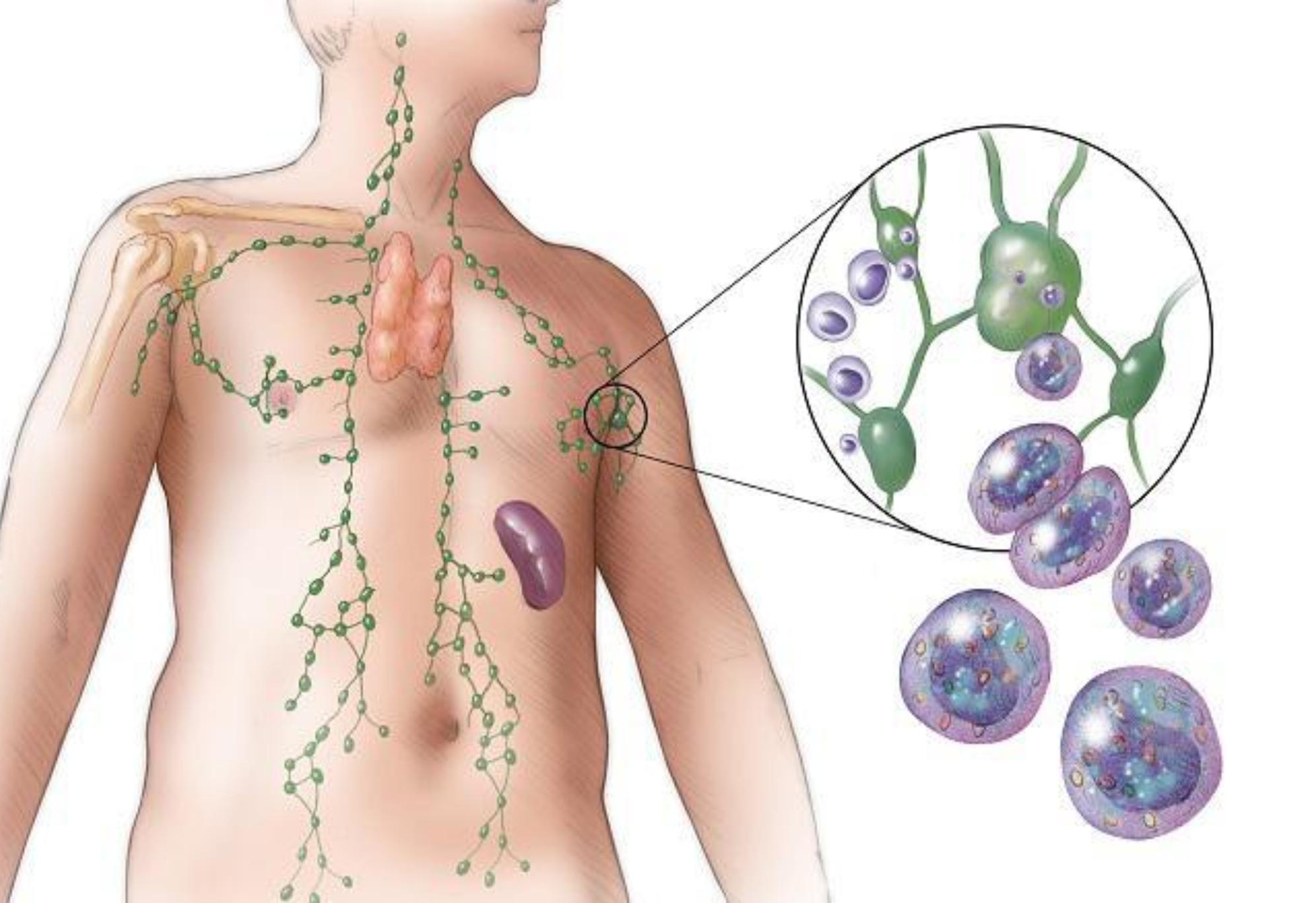 Λέμφωμα- Η νόσος που τα συμπτώματα της θυμίζουν γρίπη: Δείτε τι είναι και ποια η θεραπεία.