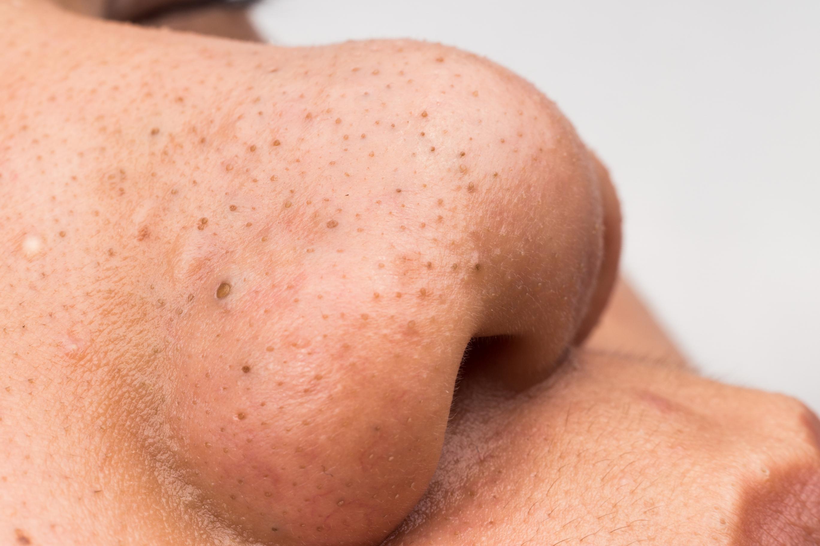 αυτοκόλλητες ταινίες-για-μαύρα-στίγματα-diy- αυτοκόλλητες ταινίες-για-μαύρα-στίγματα-diy-