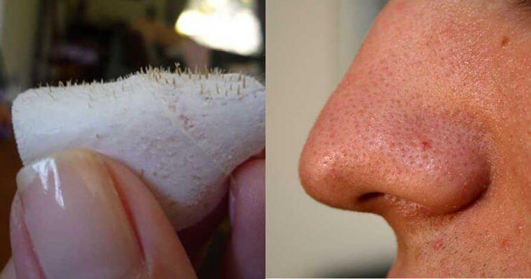 αυτοκόλλητες ταινίες-για-μαύρα-στίγματα-diy- αυτοκόλλητες ταινίες-για-μαύρα-στίγματα-diy-