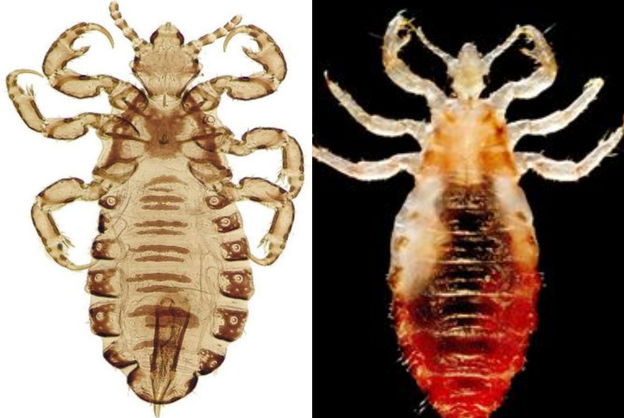 Ψείρες σώματος: Πόσο επικίνδυνες είναι τι επιπλοκές έχει το τσίμπημά τους και πως να απαλλαγείτε μια και καλή  