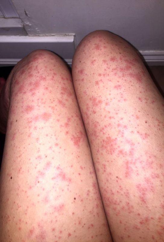 προβλήματα-υγείας-που-προκαλούνται-από-στενά παντελόνια-