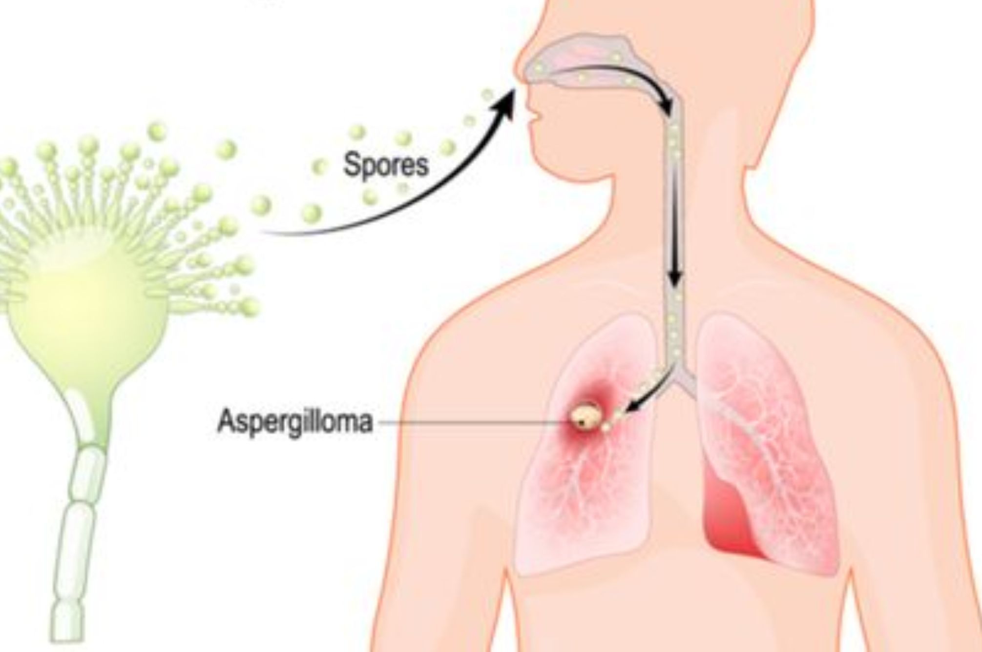 Στέγνωμα ρούχων μέσα στο σπίτι: Ποια τα προβλήματα που δημιουργούν και γιατί κινδυνεύετε απο Ασπεργίλλωση