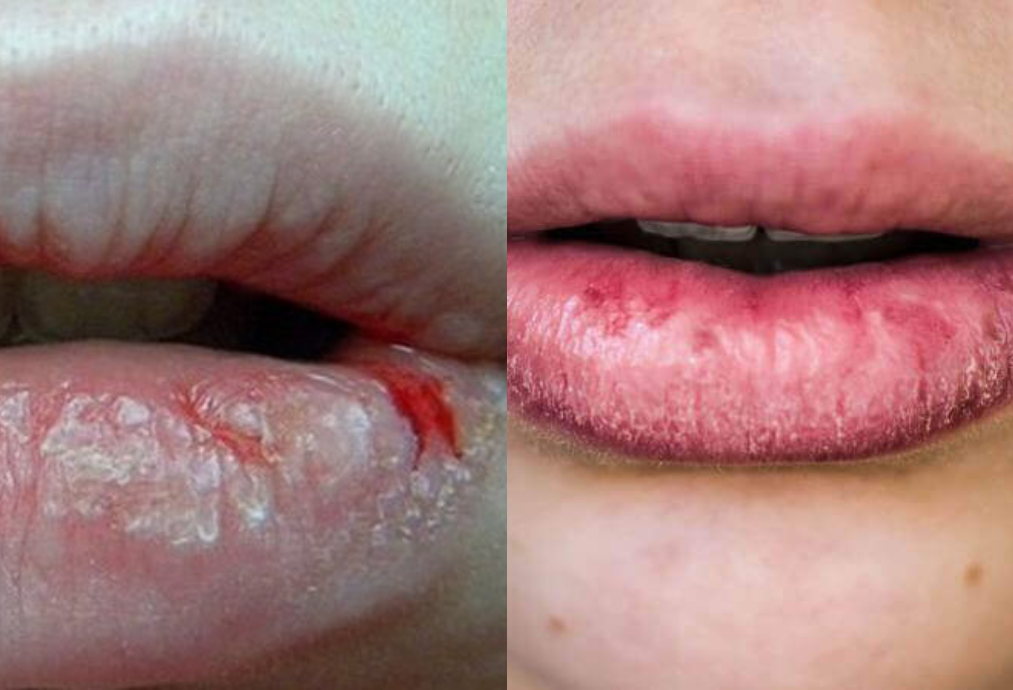 Σκασμένα χείλη τον χειμώνα : Αφυδατωμένα χείλη που ματώνουν – Οι ειδικοί συμβουλεύουν πως να τα φροντίσετε