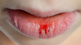 Σκασμένα χείλη τον χειμώνα : Αφυδατωμένα χείλη που ματώνουν – Οι ειδικοί συμβουλεύουν πως να τα φροντίσετε