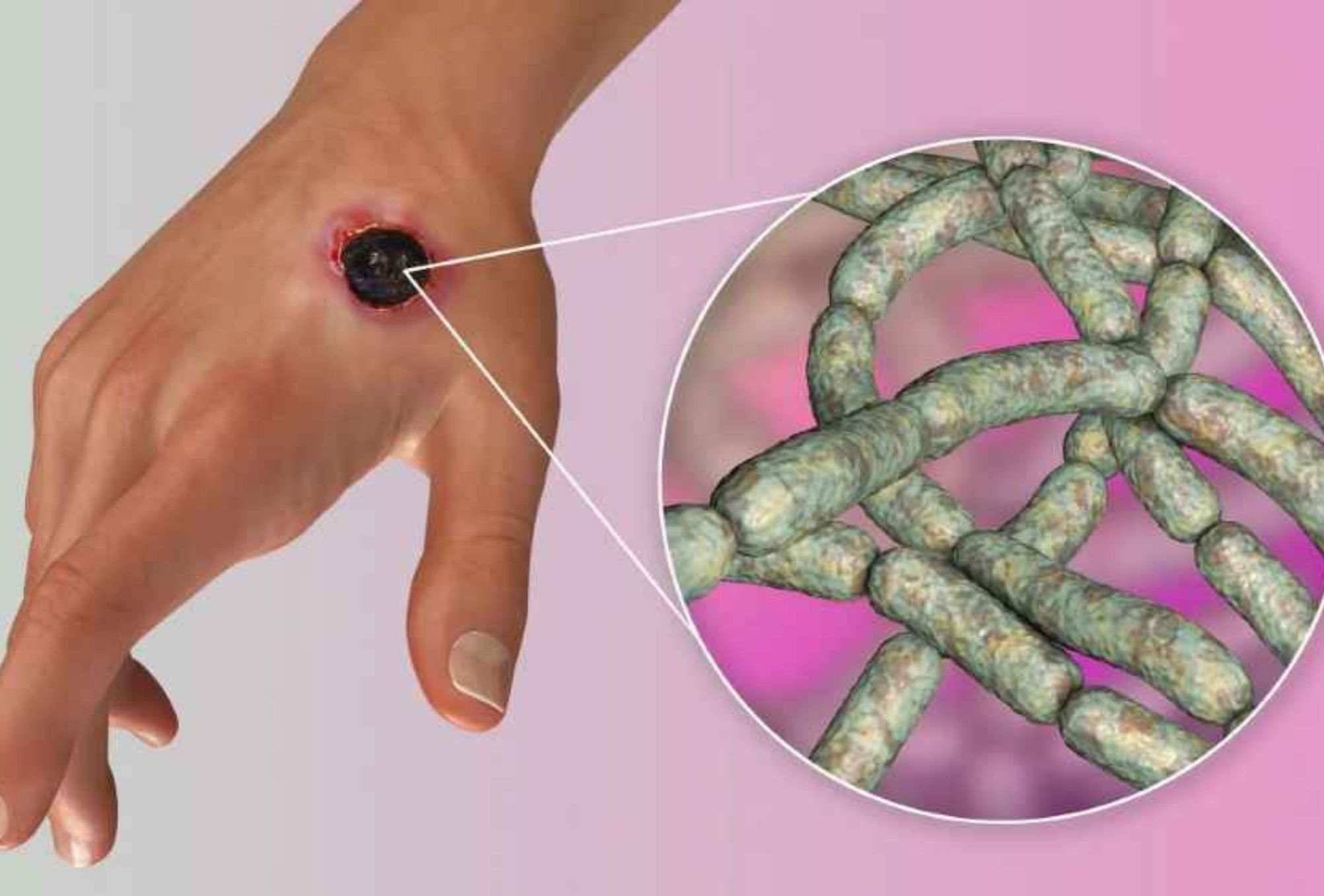 Άνθρακας μια επικίνδυνη μόλυνση: Συμπτώματα θεραπεία και πώς μεταδίδεται