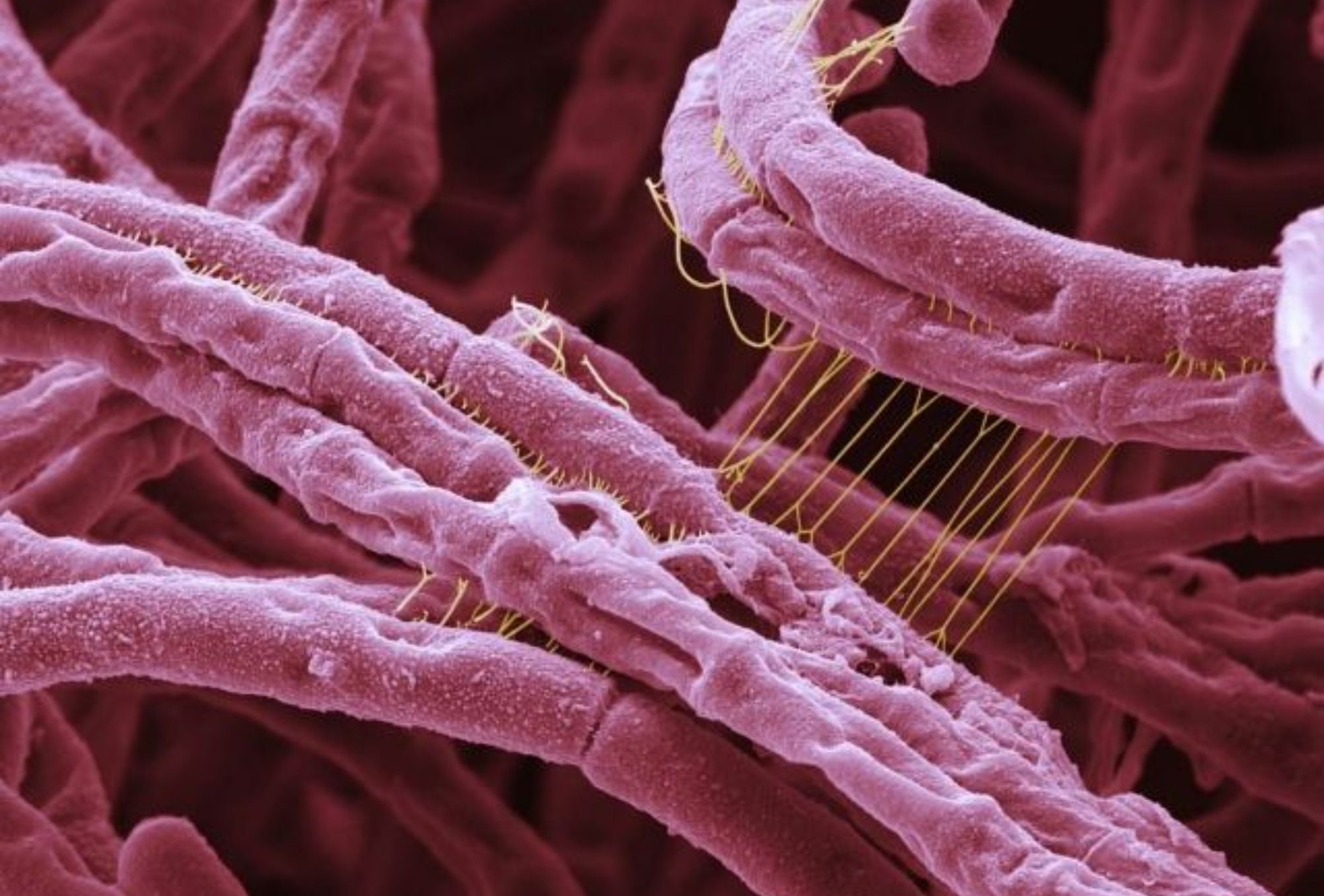 Άνθρακας μια επικίνδυνη μόλυνση: Συμπτώματα θεραπεία και πώς μεταδίδεται