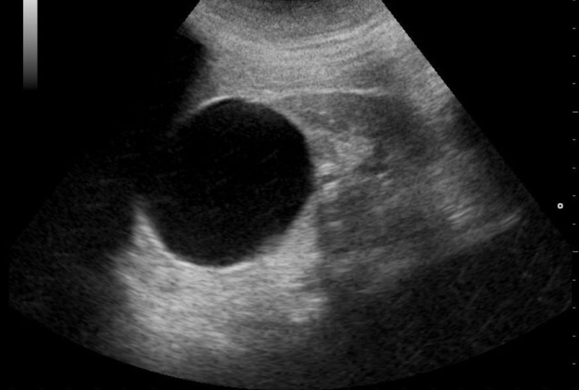 Κύστη στο νεφρό: Συμπτώματα διάγνωση και θεραπεία