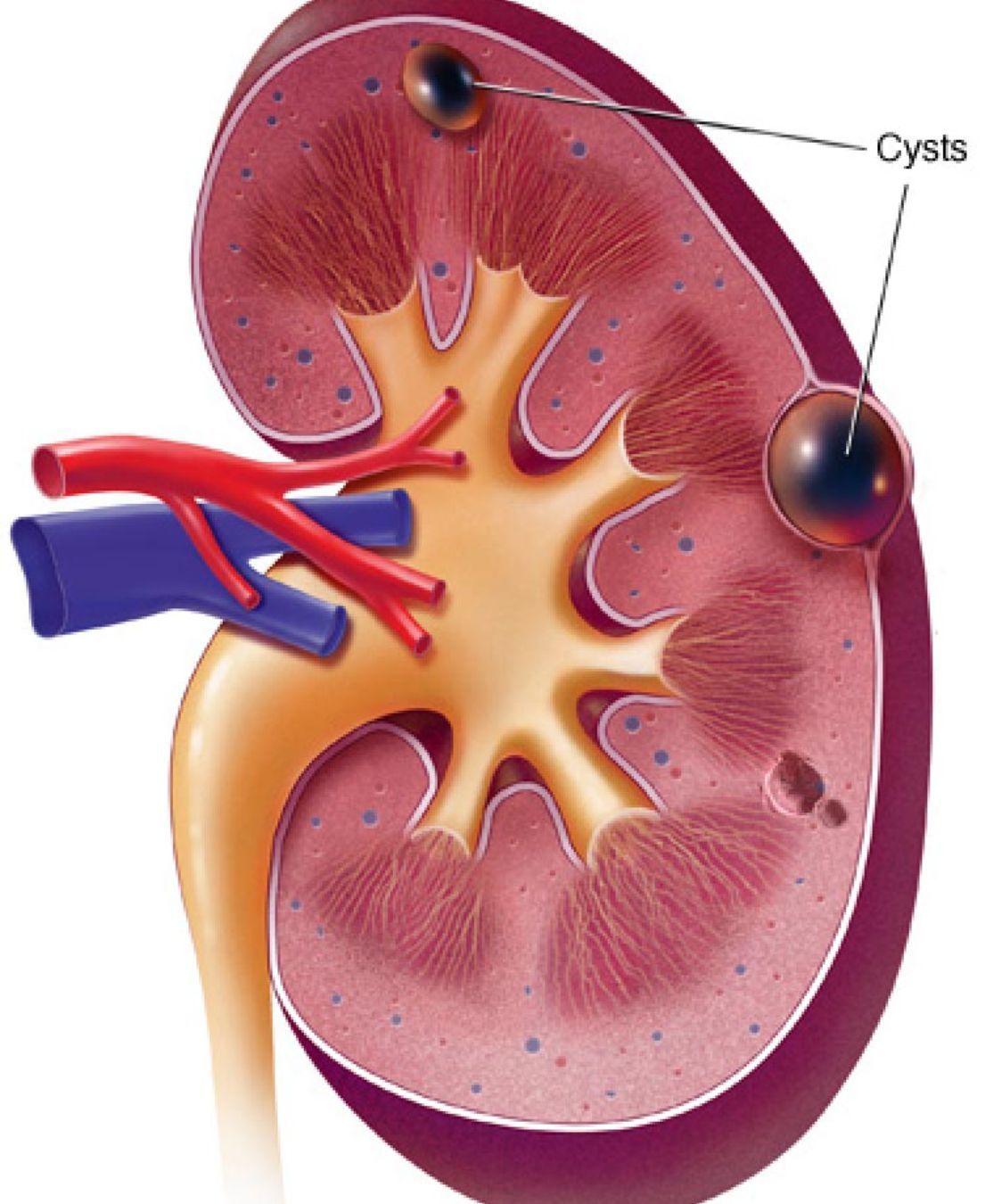 Κύστη στο νεφρό: Συμπτώματα διάγνωση και θεραπεία