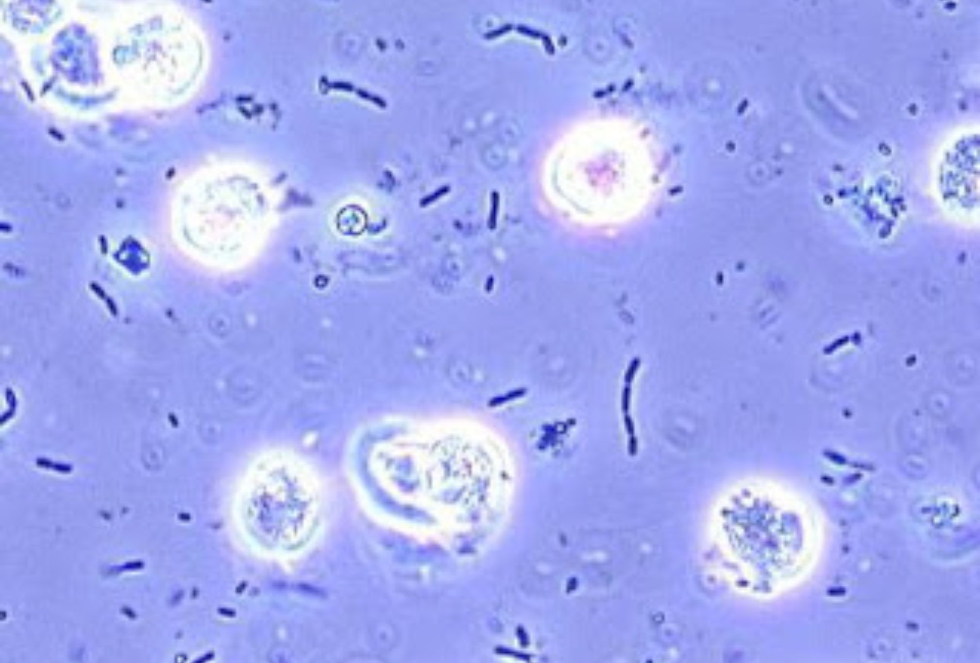 Βλέννη στα ούρα: Αιτίες συμπτώματα διάγνωση και θεραπεία