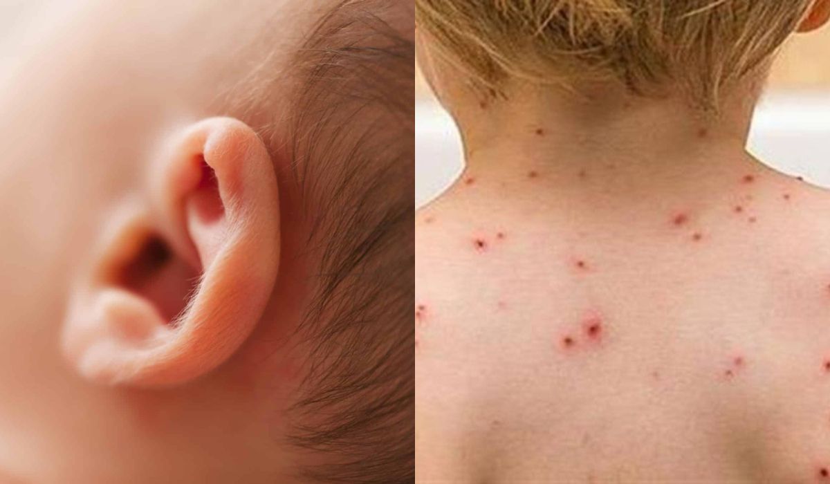 ‘Εξαρση Μηνιγγίτιδας : Γιατί χτυπά εφήβους και νέους –  Συμπτώματα