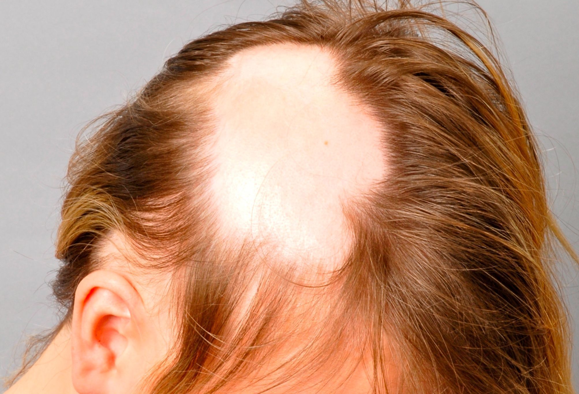 Γυροειδής αλωπεκία ή τριχοφάγος: Τι είναι ποια είναι τα αίτια τα συμπτώματα και η θεραπεία