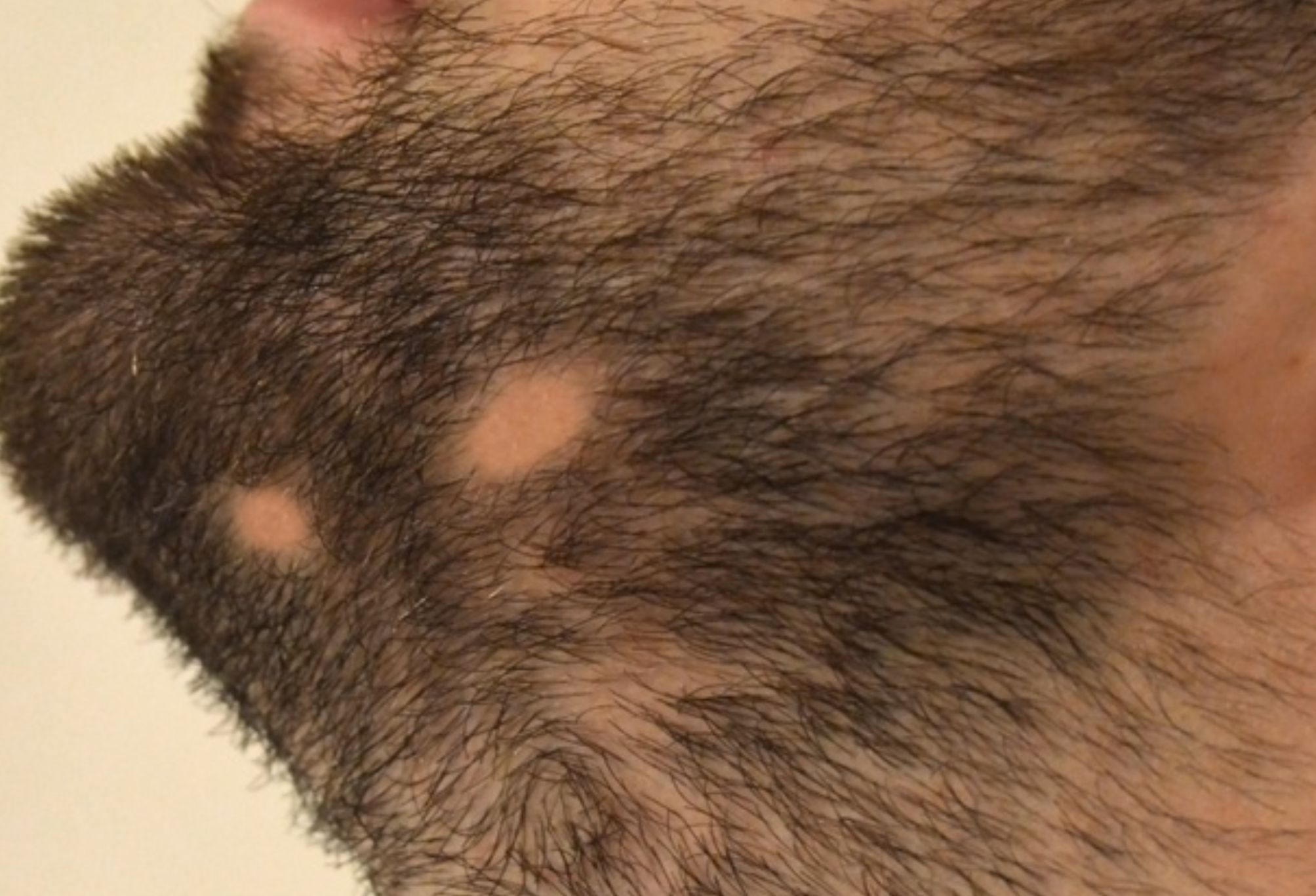 Γυροειδής αλωπεκία ή τριχοφάγος: Τι είναι ποια είναι τα αίτια τα συμπτώματα και η θεραπεία