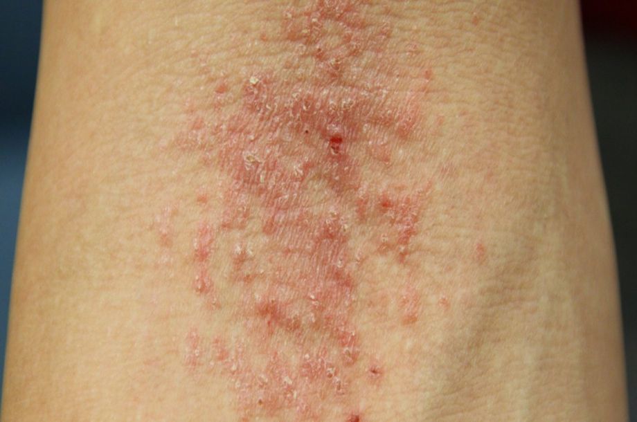 Ιπποφαές-αντικαρκινικές δράσεις-ρύθμιση σακχάρου-απώλεια βάρους- Ιπποφαές-αντικαρκινικές δράσεις-ρύθμιση σακχάρου-απώλεια βάρους-