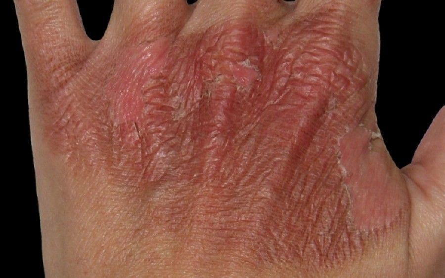 Ιπποφαές-αντικαρκινικές δράσεις-ρύθμιση σακχάρου-απώλεια βάρους- Ιπποφαές-αντικαρκινικές δράσεις-ρύθμιση σακχάρου-απώλεια βάρους-