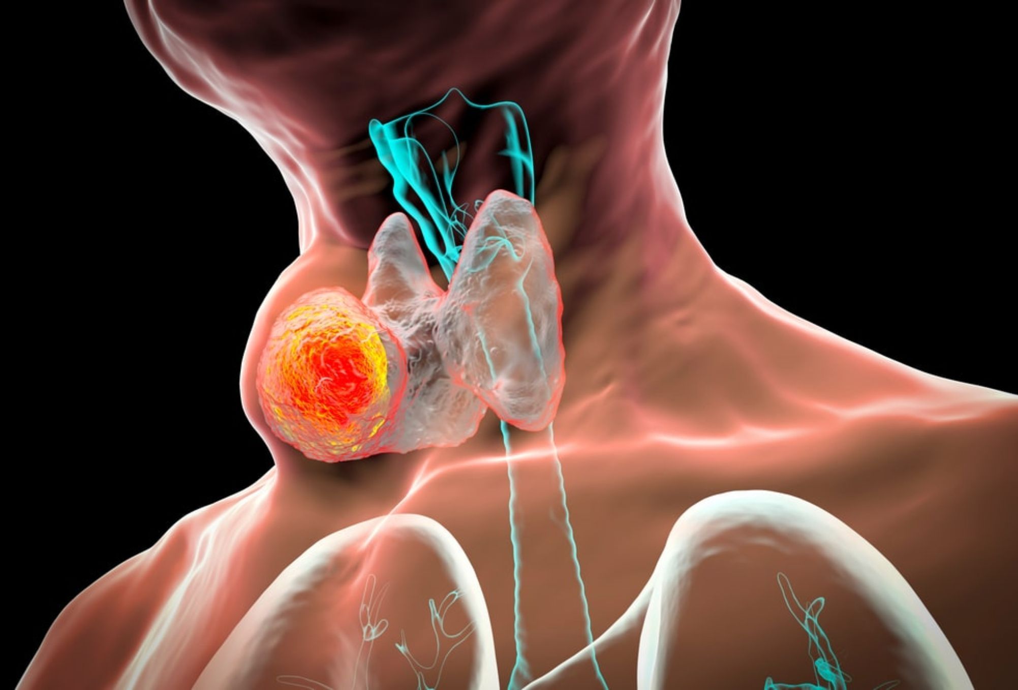 Όζοι του θυρεοειδούς: Συμπτώματα και πως τους αντιμετωπίζουμε