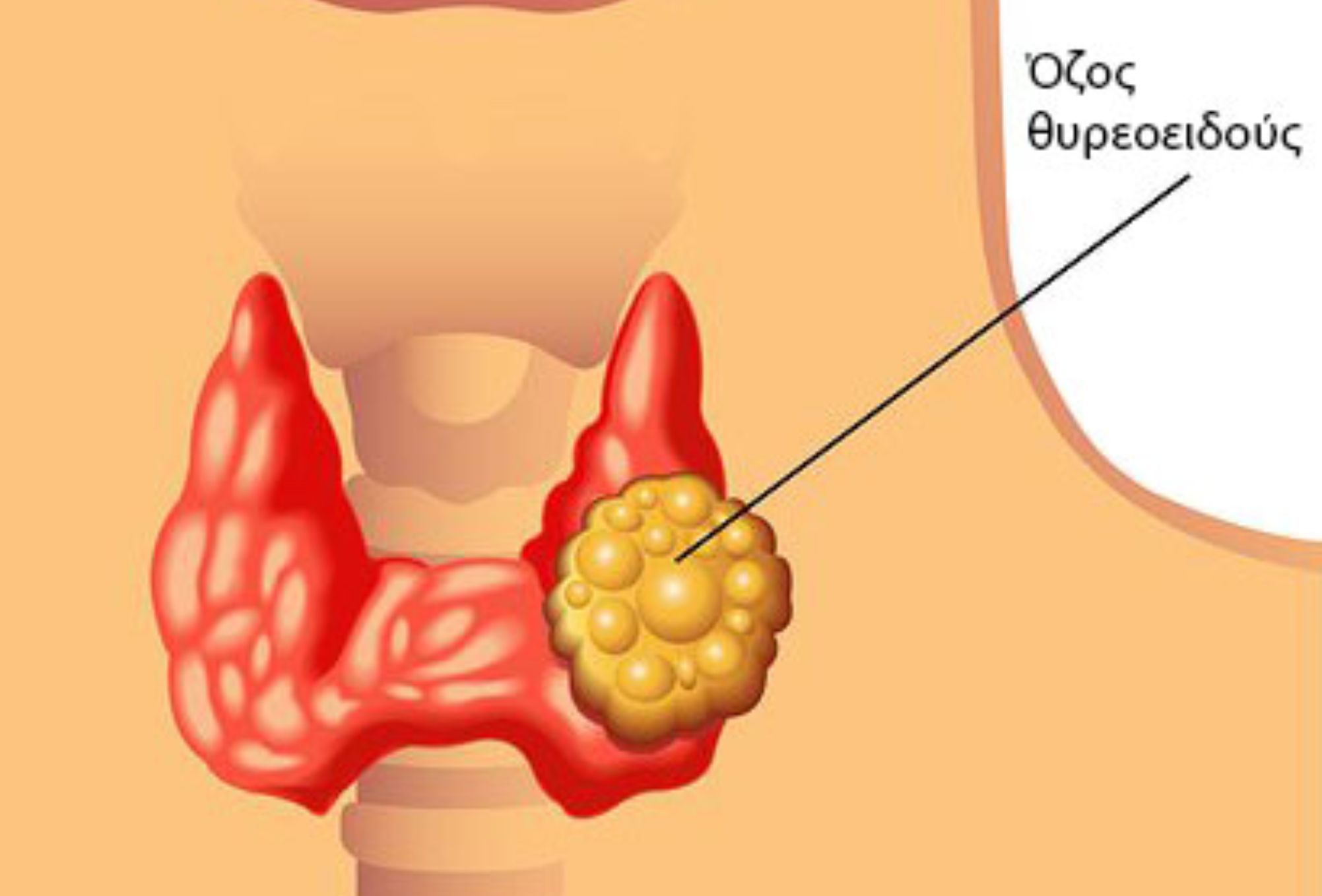 Όζοι του θυρεοειδούς: Συμπτώματα και πως τους αντιμετωπίζουμε